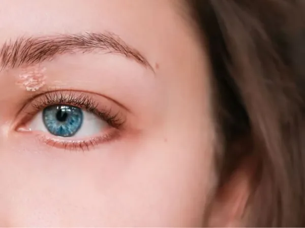 مضاد اكتئاب شائع يتسبب في تآكل جلد امرأة بنسبة 55%