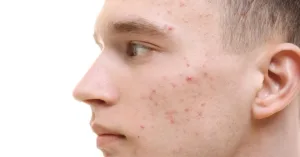 5 علاجات طبيعية قد تساعد في تقليل البقع الداكنة تدريجيًا