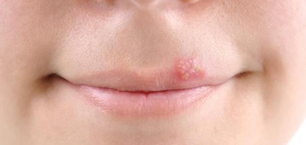 كيف تتخلص من حبوب الفم بطرق طبيعية وآمنة؟
