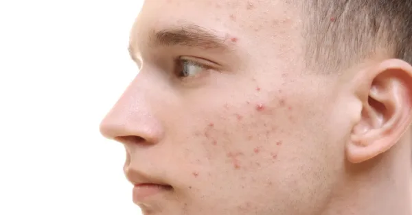 5 علاجات طبيعية قد تساعد في تقليل البقع الداكنة تدريجيًا