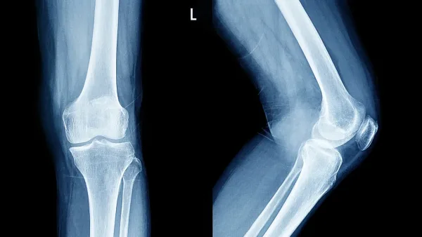 عالمة تحدد مرحلة عمرية حرجة تبدأ فيها العظام بفقدان صلابتها