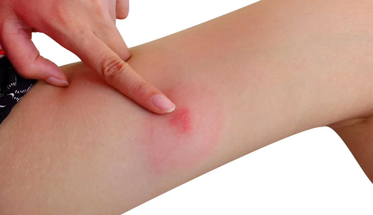 علاج لدغات البعوض بالحرارة: طريقة طبيعية فعالة تغني عن الأدوية والمراهم