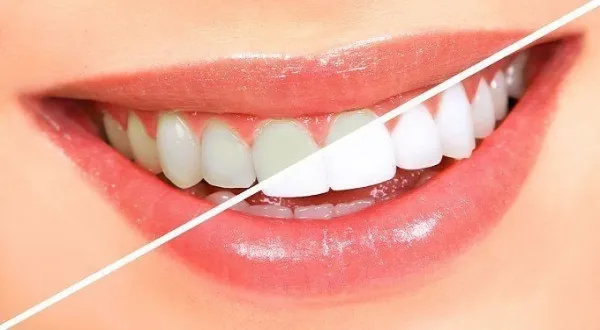 هل تنجح وصفات تبييض الأسنان المنزلية؟.. اختصاصية تحسم الجدل
