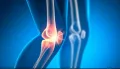 علاج مستخرج من «دم الحيض» لخشونة المفاصل.. طريقة جديدة لإعادة نمو الغضاريف