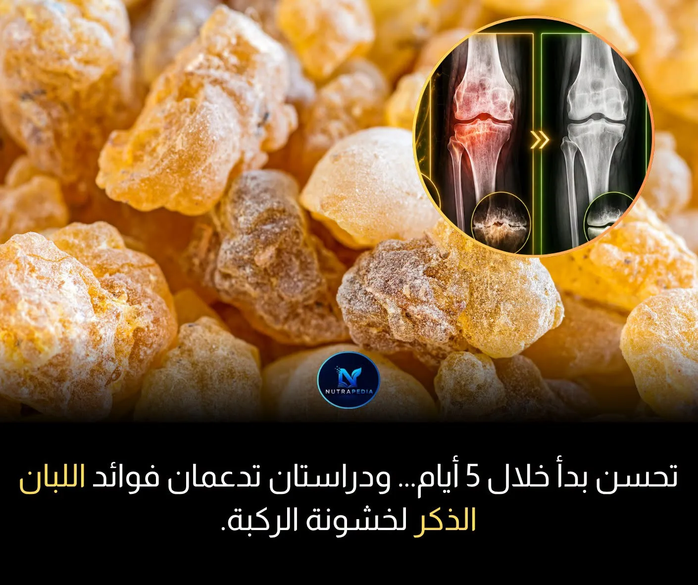 هل يمكن للّبان الذكر أن يخفف آلام خشونة الركبة؟