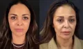 نجمات اعترفن بتجارب تجميل انتهت بالندم