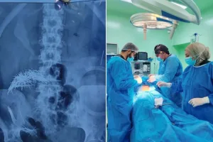 جراحة استثنائية لاستخراج 214 إبرة ودبوسا من بطن عراقي