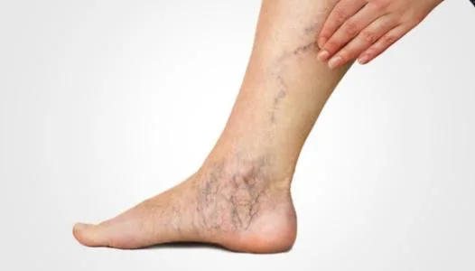 هل تقف أو تجلس طويلًا؟.. عادات يومية قد تزيد خطر دوالي الساقين
